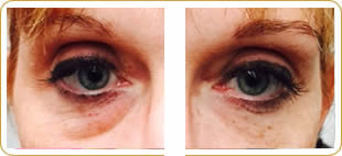 Before and after Eyevittal 