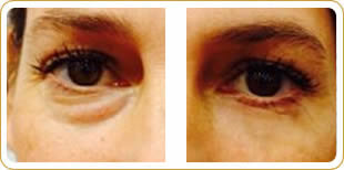 Eyevittal eye lift - before and after photos